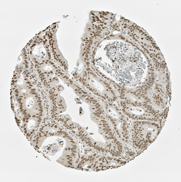 IHC of colon cancer cells labeled with DSHB antibody CPTC-ARG1-1 against Arginase 1 Peptide 1. Image Credit: NCI-Clinical Proteomic Technologies for Cancer.